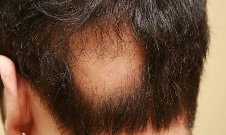 ریزش موی سکه‌ای چگونه درمان می‌شود؟