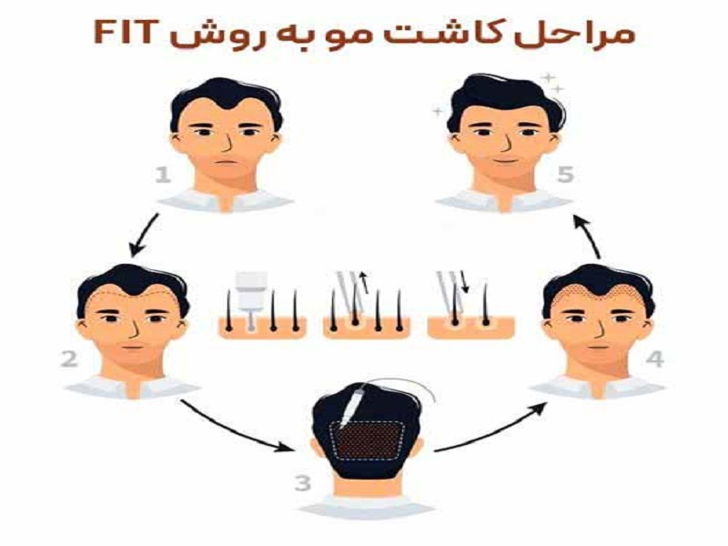 مراحل کاشت مو به روش FIT | متخصص پوست اصفهان - بهترین متخصص ژل و بوتاکس - بهترین متخصص تزریق چربی و لیپوترانسفر