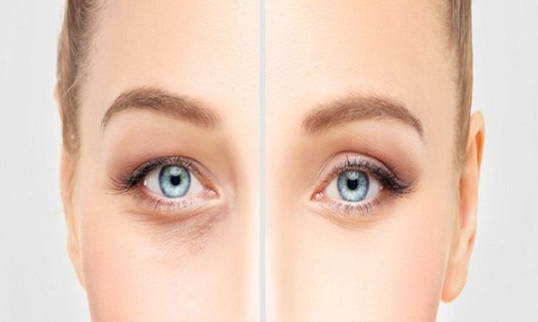 چهار مرحله اصلی عمل زیبایی پلک