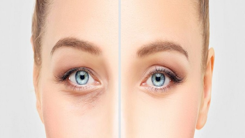 خطرات و عوارض جراحی پلک | متخصص پوست اصفهان - بهترین متخصص ژل و بوتاکس - بهترین متخصص تزریق چربی و لیپوترانسفر