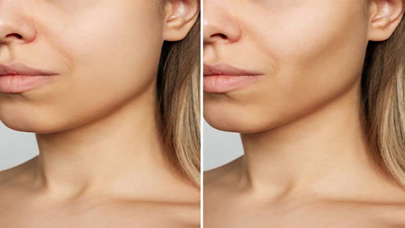 جراحی تخلیه چربی صورت در تعریف پزشکی چیست؟ | متخصص پوست اصفهان - بهترین متخصص ژل و بوتاکس - بهترین متخصص تزریق چربی و لیپوترانسفر