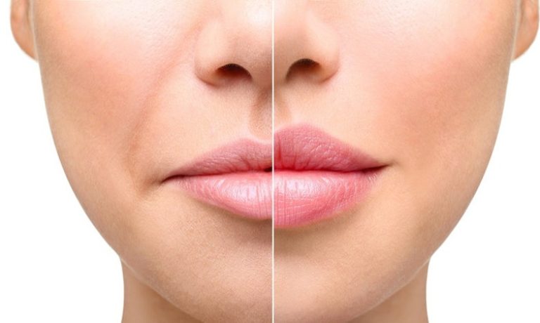 تفاوت بین بوتاکس و فیلر: مقایسهای جامع