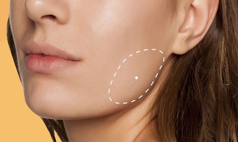 جراحی تخلیه چربی صورت در تعریف پزشکی چیست؟