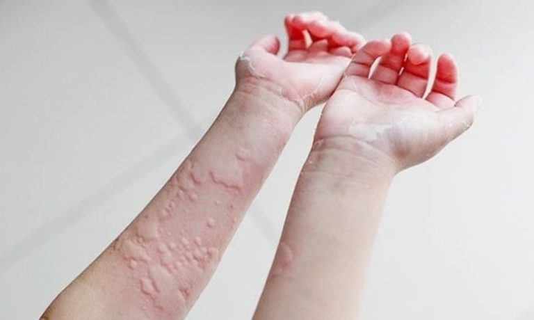 پوست حساس و تاثیر آن بر واکنش‌های آلرژیک و سلامت روان