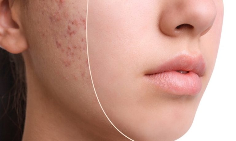 روش‌های نوین درمان آکنه