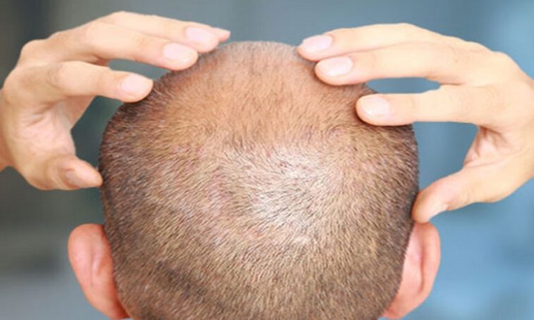 سوالات متداول بیماران دیابتی در مورد کاشت مو