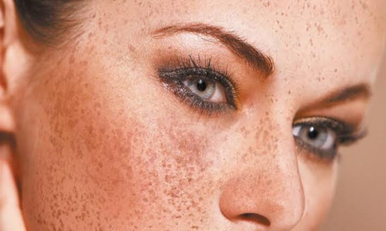 مشکلات شایع پوستی و درمانهای خانگی