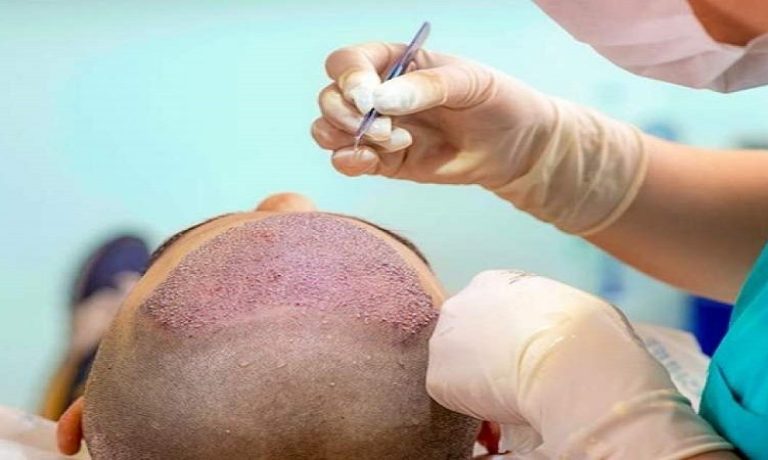 اطمینان از کاشت مو ایمن برای بیماران دیابتی