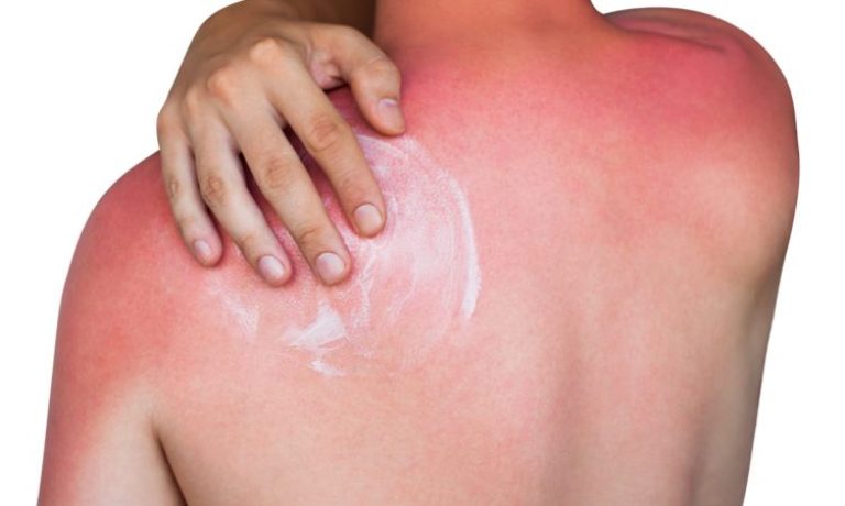 بررسی انواع آلرژی پوست به نور خورشید