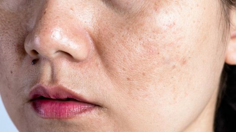 بیماری هایپوپیگمانتاسیون پوست | بهترین متخصص ژل و بوتاکس