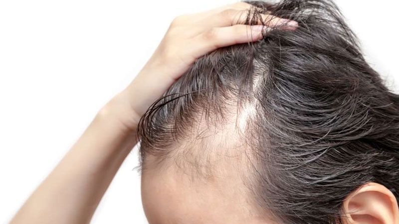 کاهش ریزش مو در پسوریازیس پوست‌ سر | متخصص پوست اصفهان