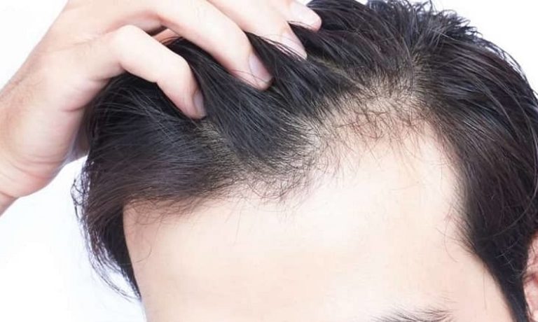 اقدامات قبل از کاشت مو در صورت ابتلا به دیابت