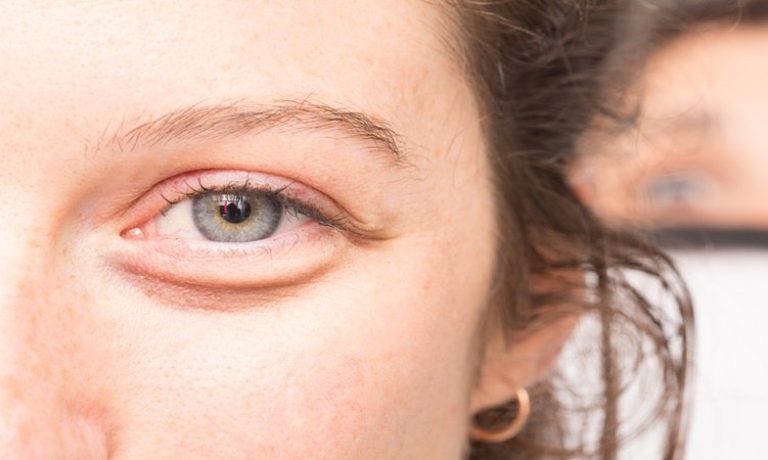 علل و علائم پف زیر چشم چیست؟