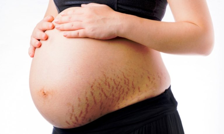 علل و عوامل ترک پوستی در بارداری