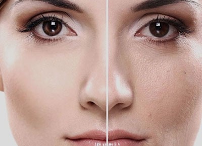 متخصص پوست اصفهان | مزوتراپی در مقایسه با لیپوساکشن