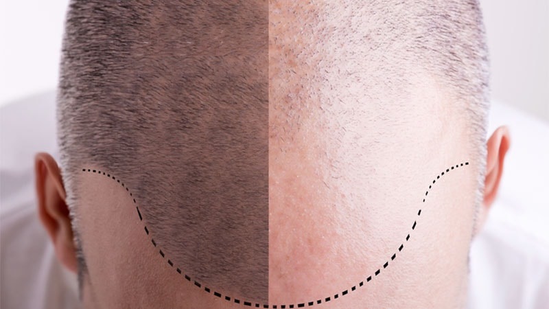 عوارض کاشت مو به روش fit | متخصص پوست اصفهان - بهترین متخصص ژل و بوتاکس - بهترین متخصص تزریق چربی و لیپوترانسفر